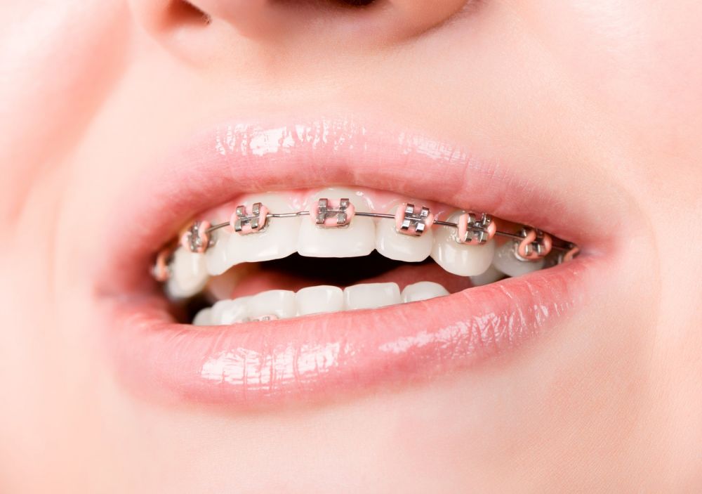 La ortodoncia en la Clínica Dental Doctor Tourón